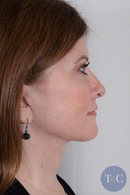 Facelift Before & After Patient #1043