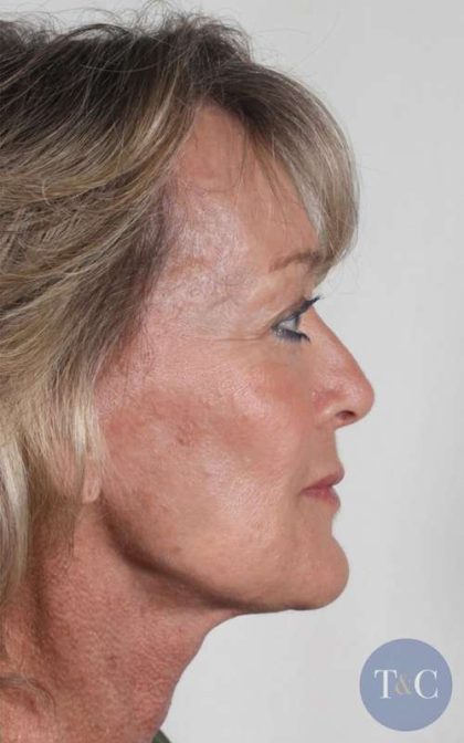 Neck Lift Before & After Patient #1080