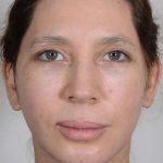 Neck Lift Before & After Patient #1085