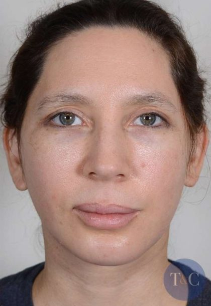 Neck Lift Before & After Patient #1085