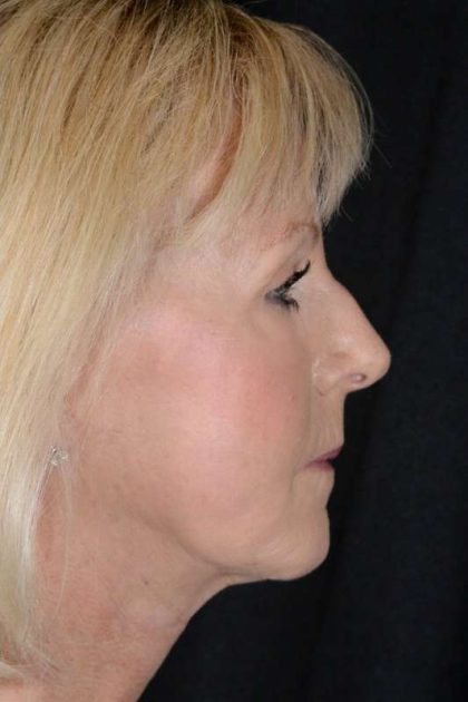 Neck Lift Before & After Patient #1090