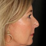 Neck Lift Before & After Patient #1095