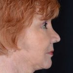 Neck Lift Before & After Patient #1100