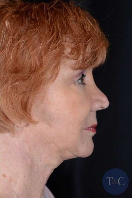 Neck Lift Before & After Patient #1100