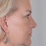 Neck Lift Before & After Patient #1110