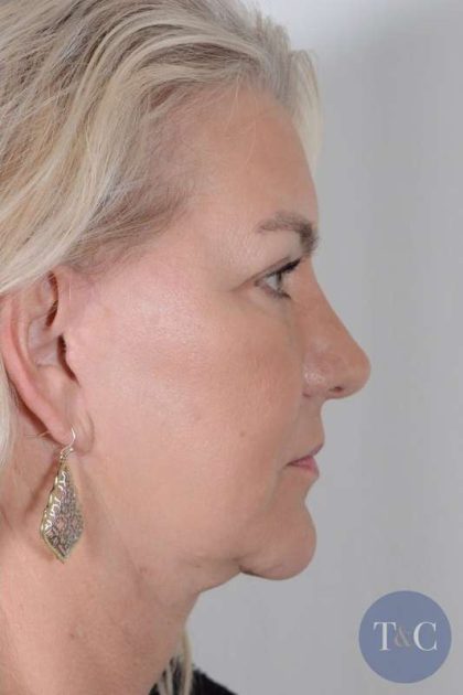 Neck Lift Before & After Patient #1110