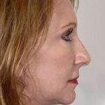 Neck Lift Before & After Patient #1125