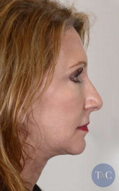 Neck Lift Before & After Patient #1125