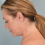 Neck Lift Before & After Patient #1157