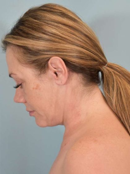 Neck Lift Before & After Patient #1157