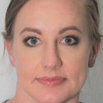 Brow Lift Before & After Patient #1184