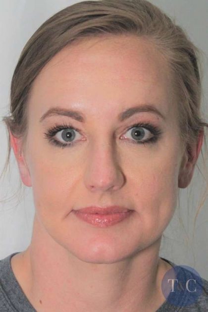 Brow Lift Before & After Patient #1184