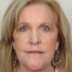 Brow Lift Before & After Patient #1187