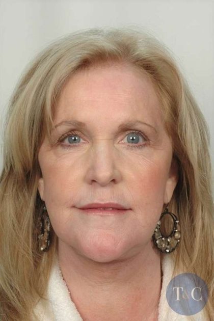 Brow Lift Before & After Patient #1187