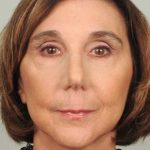 Brow Lift Before & After Patient #1193