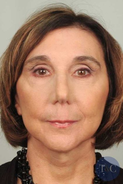 Brow Lift Before & After Patient #1193