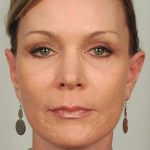 Brow Lift Before & After Patient #1196