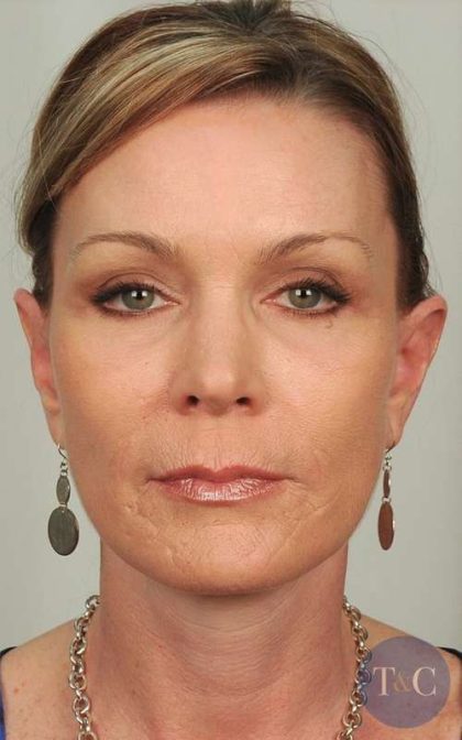 Brow Lift Before & After Patient #1196