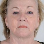 Facial Fat Transfer & Grafting Before & After Patient #1208