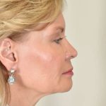 Facial Fat Transfer & Grafting Before & After Patient #1215