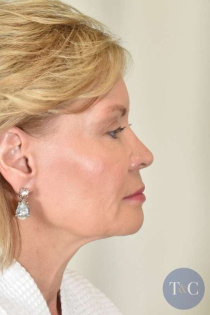 Facial Fat Transfer & Grafting Before & After Patient #1215