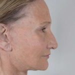 Facial Fat Transfer & Grafting Before & After Patient #1220