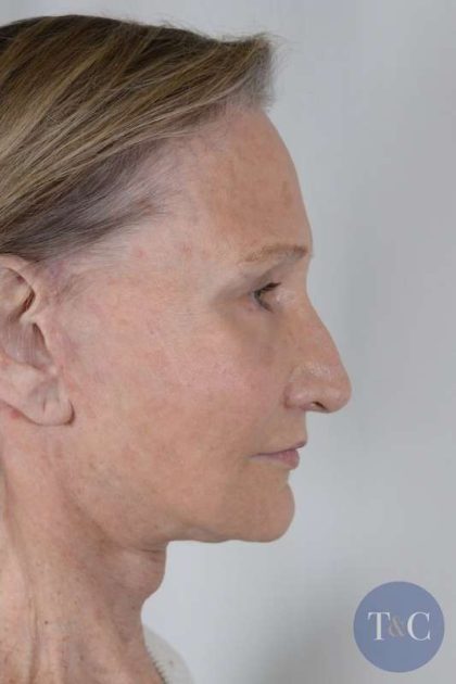 Facial Fat Transfer & Grafting Before & After Patient #1220