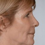Facial Fat Transfer & Grafting Before & After Patient #1225