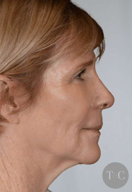 Facial Fat Transfer & Grafting Before & After Patient #1225