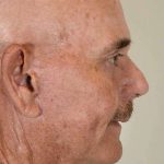 Facial Fat Transfer & Grafting Before & After Patient #1235