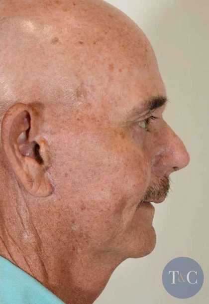 Facial Fat Transfer & Grafting Before & After Patient #1235
