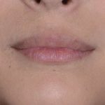 Facial Fat Transfer & Grafting Before & After Patient #1238