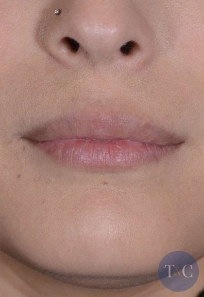Facial Fat Transfer & Grafting Before & After Patient #1238