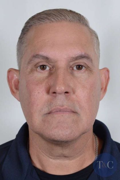 Men's Facelift Before & After Patient #1244