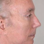 Men's Facelift Before & After Patient #1249