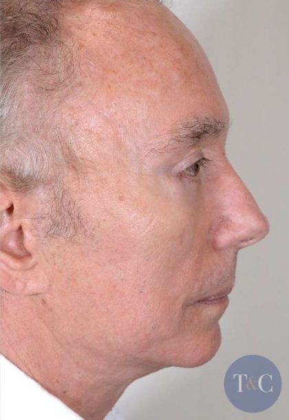 Men's Facelift Before & After Patient #1249