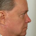 Men's Facelift Before & After Patient #1254