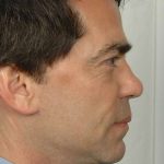 Men's Facelift Before & After Patient #1259