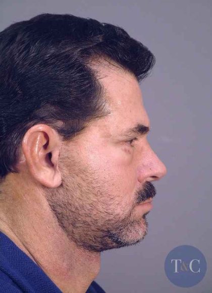 Men's Facelift Before & After Patient #1264