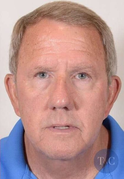 Men's Facelift Before & After Patient #1269