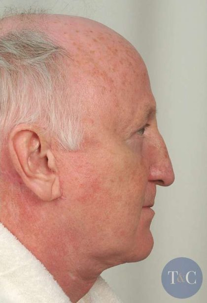 Men's Facelift Before & After Patient #1279