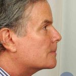 Men's Facelift Before & After Patient #1282