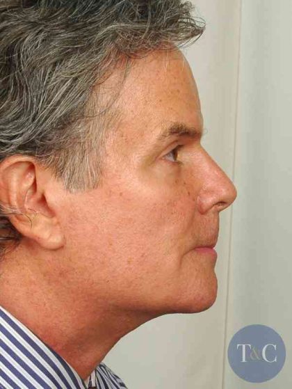 Men's Facelift Before & After Patient #1282