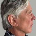 Men's Facelift Before & After Patient #1285