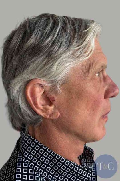 Men's Facelift Before & After Patient #1285