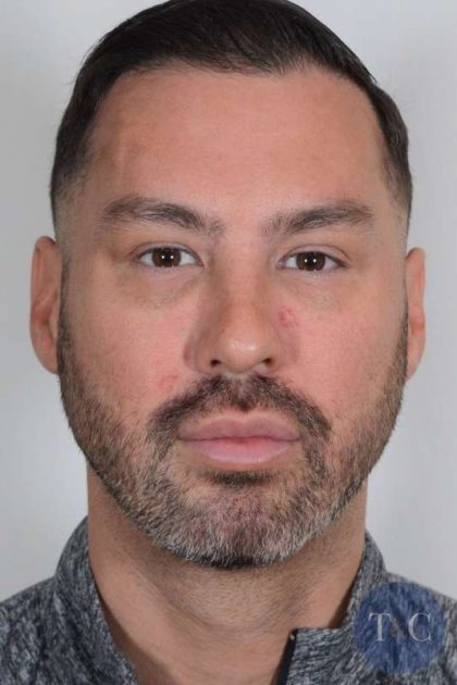 Men's Necklift Before & After Patient #1288