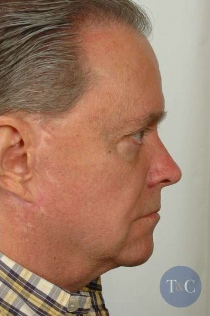 Men's Necklift Before & After Patient #1301