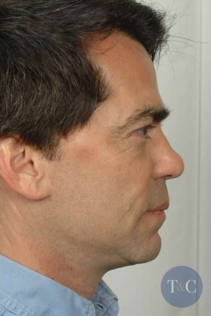 Men's Necklift Before & After Patient #1306