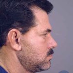 Men's Necklift Before & After Patient #1311