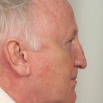 Men's Necklift Before & After Patient #1326
